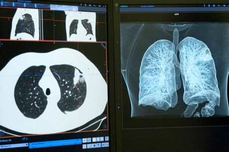 HC Marbella advierte sobre los peligros que entraña para los pulmones el vapeo